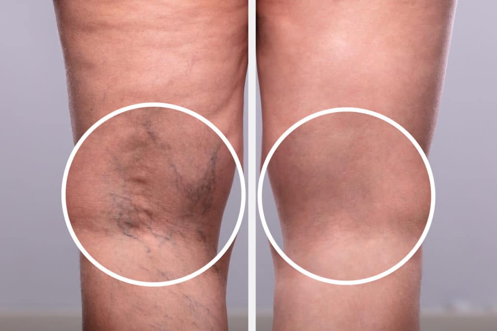 Varicose Vein Treatment Toronto Downtown